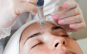 Microneedling procedure being done on a women meanwhile PRP is injected